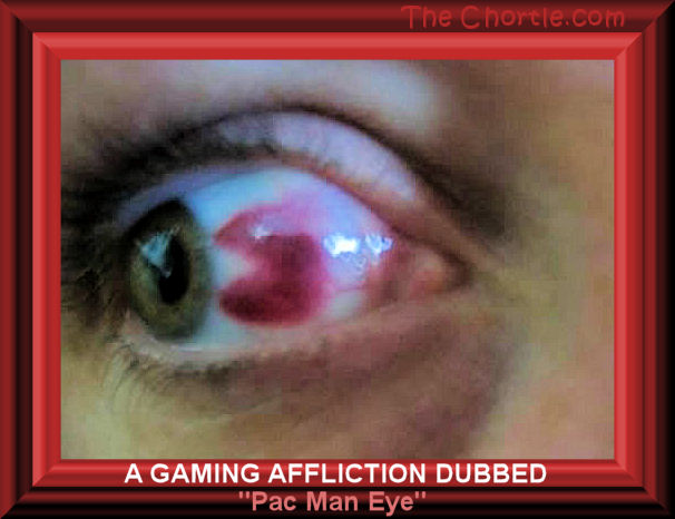 A gaming affliction dubbed "Pac Man Eye" 