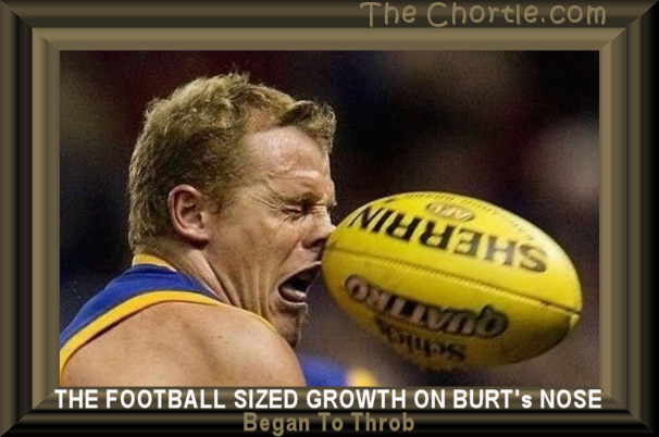 The football sized growth on Burt's nose began to throb.